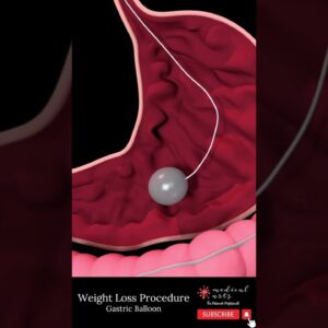 GASTRIC BALLOON [] bariatric surgery [] weight loss surgery #shorts