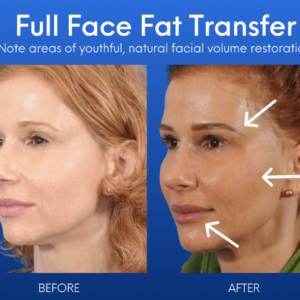 What is face fat?